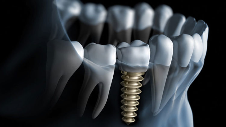Implantes Dentários O que são?