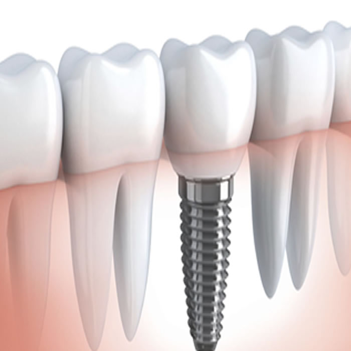 Implantes e Cirurgias Corretivas, Dentista Porto Alegre